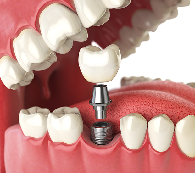 Philadelphia Will I Need a Bone Graft for Dental Implants