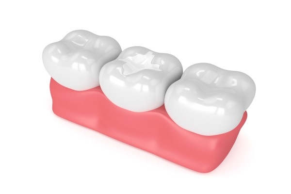 Types Of Tooth Fillings: When Are Each Recommended?