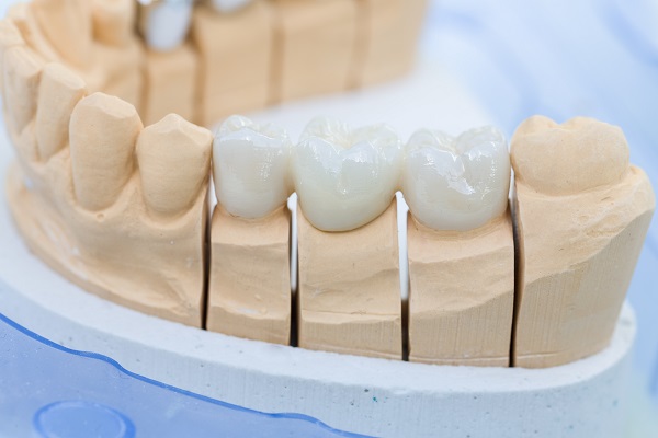 Popular Dental Crown Materials