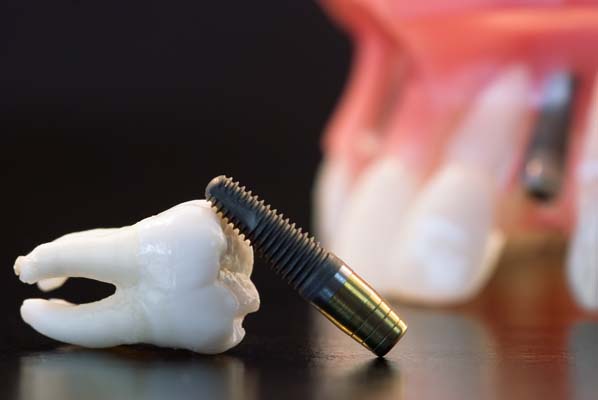 Why You Should Not Fear The Surgery To Get Tooth Implants